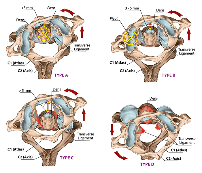 Подвывих шейного позвонка - признаки, причины, симптомы, лечение и профилактика - riderpark-tour.ru