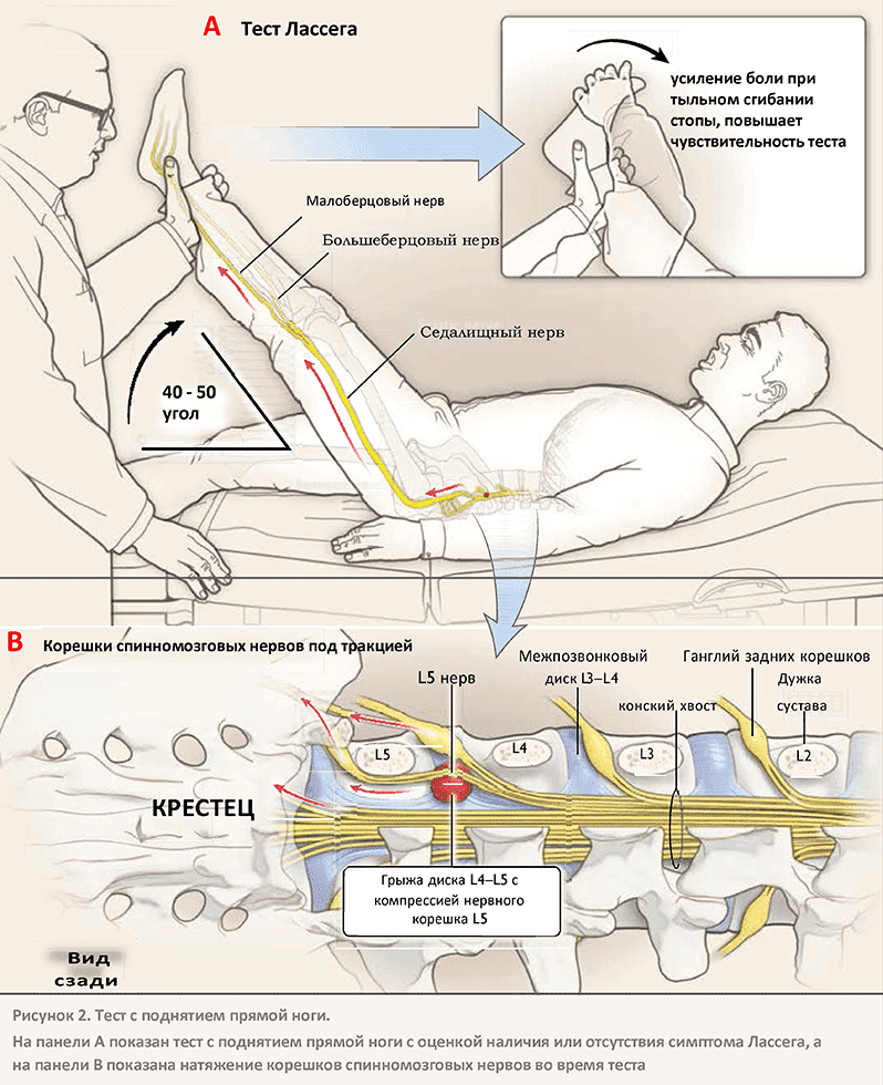 Ишиас лечение
