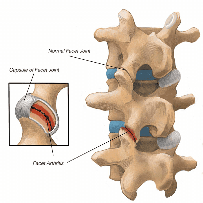 Спондилоартроз. Дугоотросчатые суставы позвоночника. Median Atlantoaxial Joint. Дисфункция дугоотросчатых суставов.