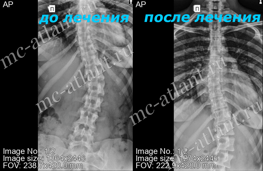 Льюис сейр лечение сколиоза фото