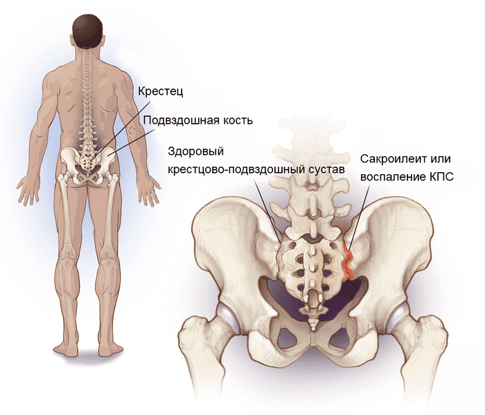 Артроз крестцово-подвздошных сочленений: признаки и лечение