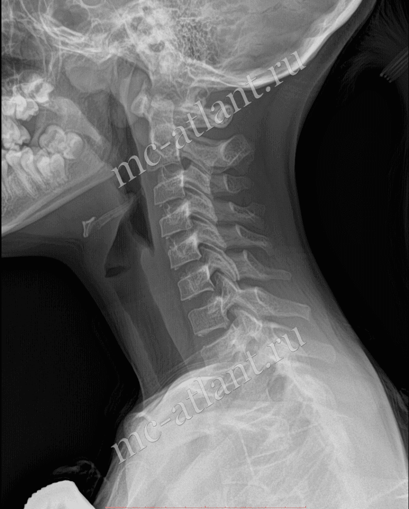 Статья диагностика шейного отдела позвоночника на сайте  https://mc-atlant.ru - Медицинская клиника 